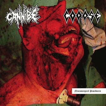 Cannibe : Neurosurgical Procedures